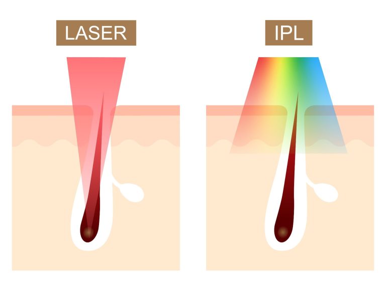 Microneedling