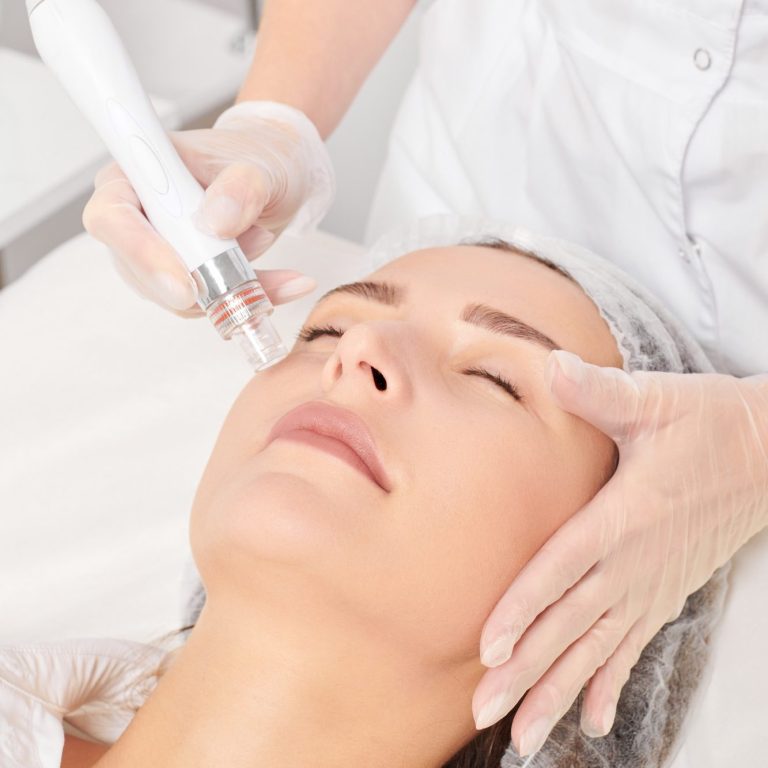 Microneedling