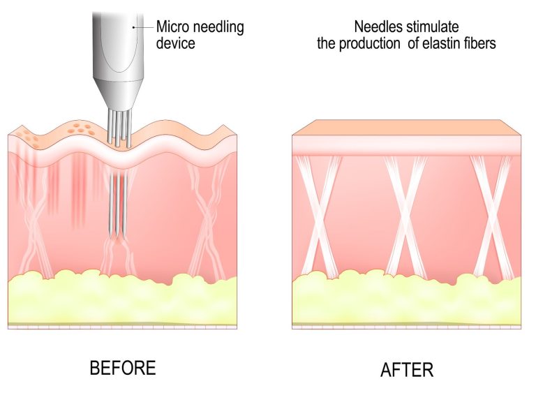 Microneedling